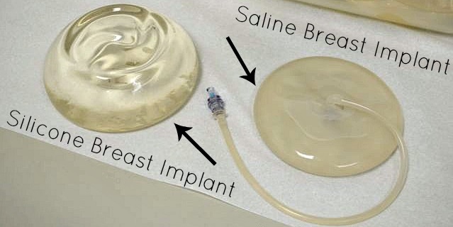 Saline Vs Silicone Gel Implants 74